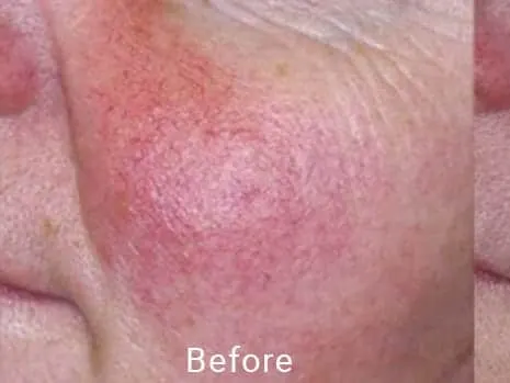 Rosacea treatment at FADC