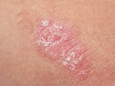 Psoriasis Treatment Coral Gables FL