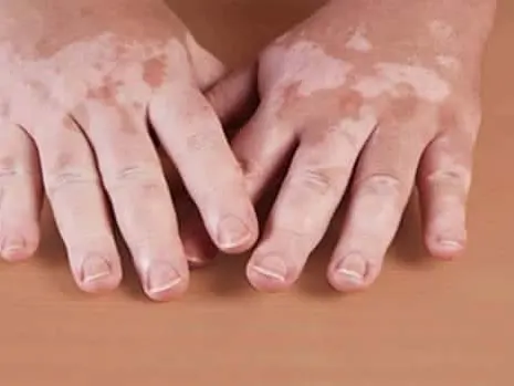pair of hands laying on table with varying levels of pigment, or vitiligo