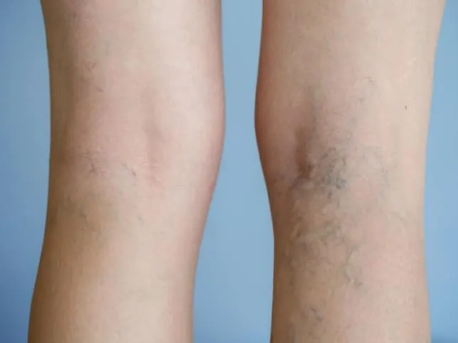 Am I a Good Candidate for Excel V Laser Treatment?