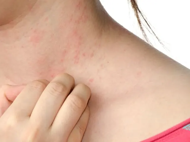 Stress and Eczema