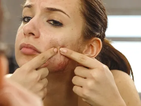 woman with acne looking herself on the mirror - acne treatment coral gables fl