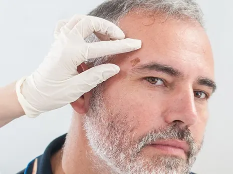 female dermatologist examining male patient's mole above eyebrow