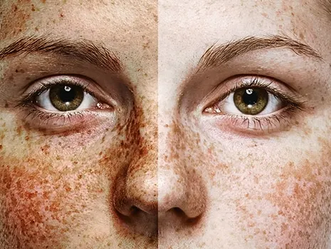 healthy skin vs sun damaged skin comparison