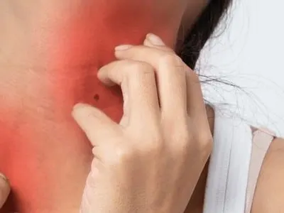 Stock photograph of a model: a woman scratching her reddened neck and shoulder