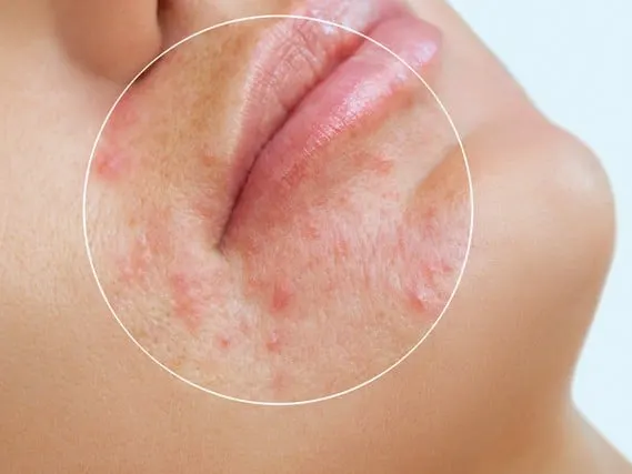 Stock photograph of a model: close-up of a chin and lips with a circle highlighting small red blemishes
