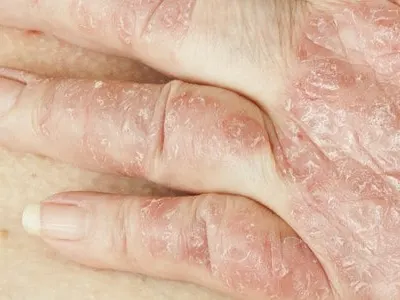 Stock photograph: close-up of a hand with red, scaly, flaking patches of skin across the knuckles