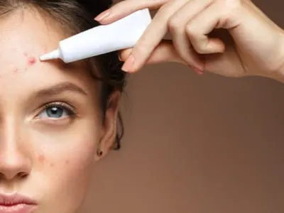 Stock photograph of a model: a woman with blemishes on her face holding a small tube of cream to her forehead