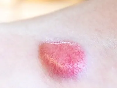 Stock photograph: close-up of a raised, pink-red spot on pale skin of a shoulder