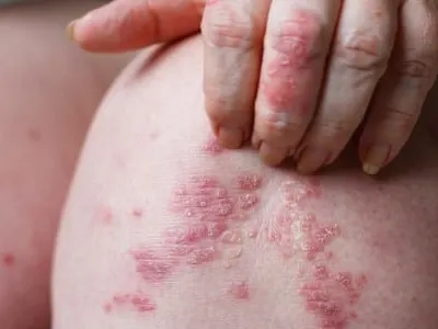 Stock photograph: close-up of a pair of knees with red, scaly patches of skin, one hand resting on a knee
