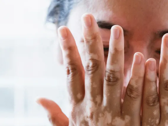 Stock photograph of a model: a person covering their face with both hands, which show lighter patches of skin