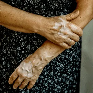 Stock photograph of a model: an older woman in a patterned dress with arms crossed, hands showing lighter patches of skin