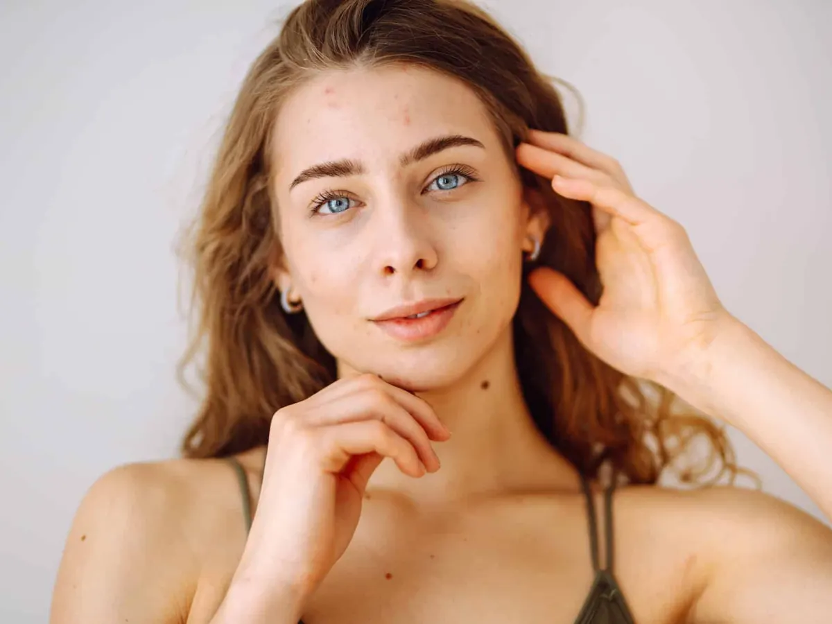 Beautiful young girl with problem skin. Young woman with wavy hair gently touching her face.Dermatology, cosmetology, skin care. Natural skin.