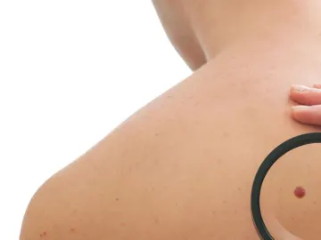 Stock photograph of models: a clinician examining a mole on a person's back, with a magnifying lens over the spot