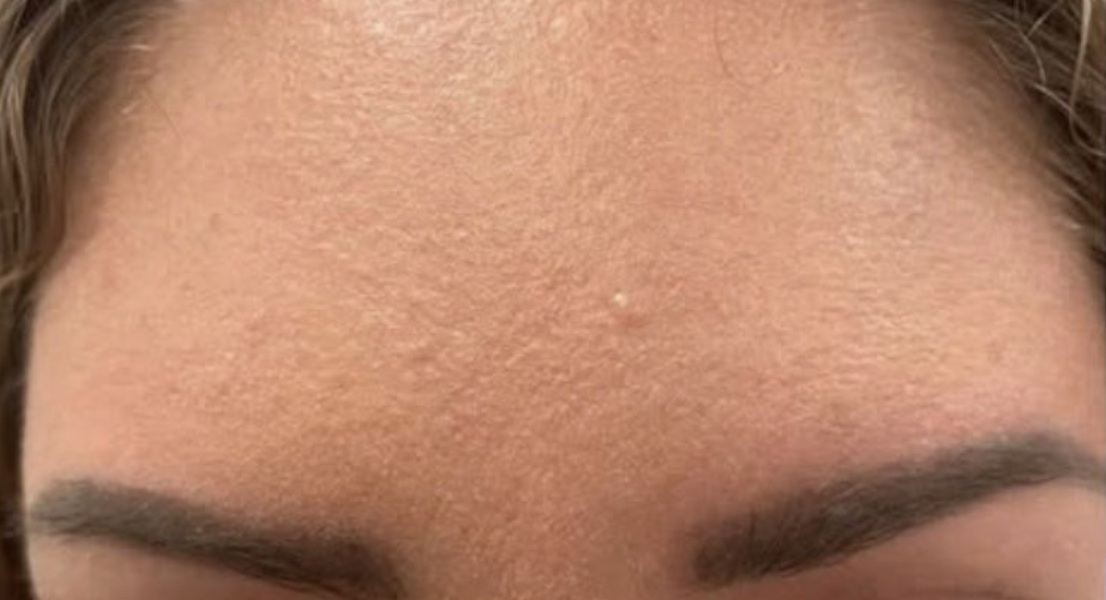 Botox before and after, frown lines between the brows: after treatment, a patient's smooth forehead