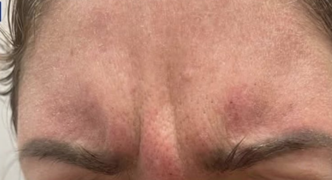 Botox before and after, frown lines between the brows: before treatment, a patient's furrowed brow with vertical creases