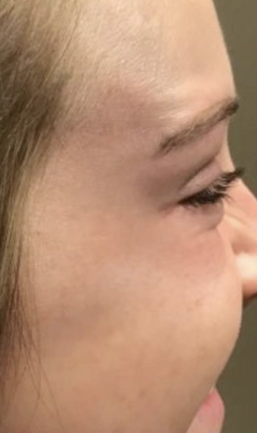 Botox before and after, crow's feet: after treatment, a patient's smooth skin beside the eye