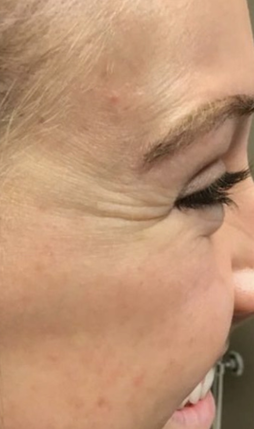 Botox before and after, crow's feet: before treatment, a patient's smiling eye with fine lines at the corner