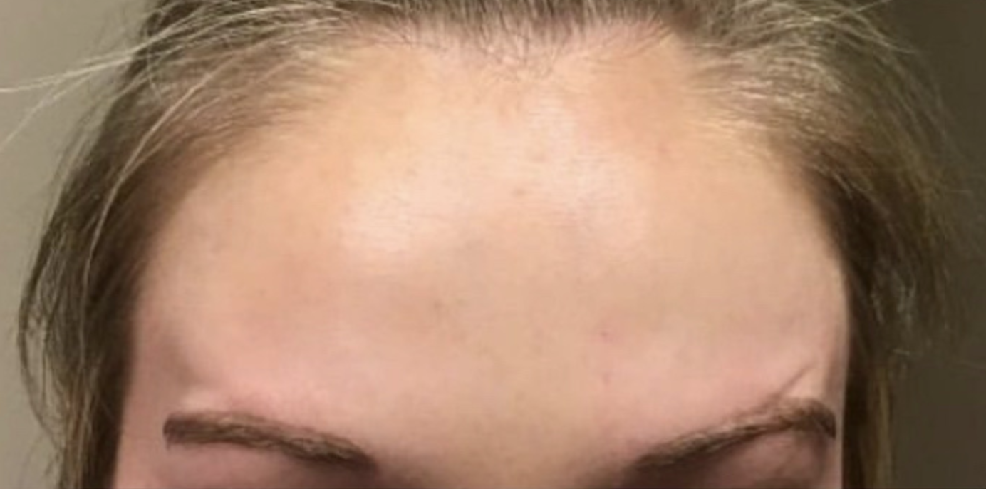 Botox before and after, forehead lines: after treatment, a woman's smooth forehead
