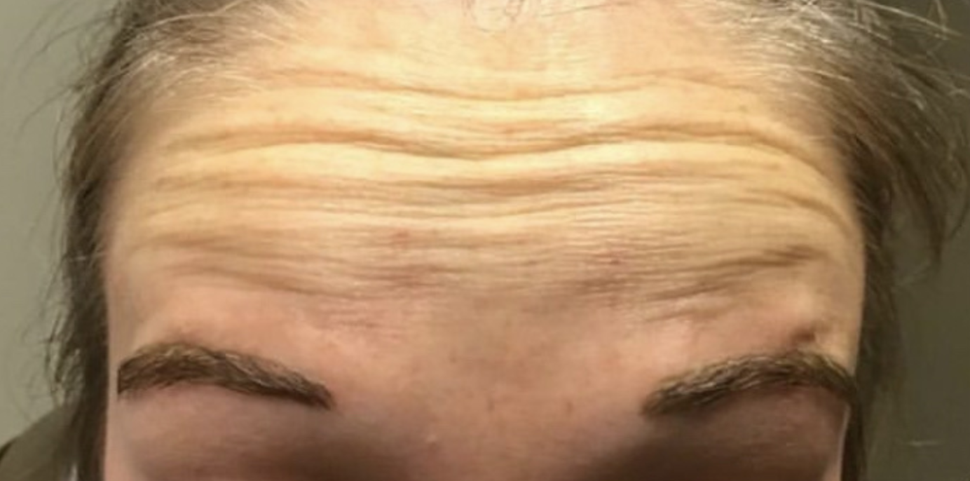 Botox before and after, forehead lines: before treatment, a woman's forehead with horizontal lines