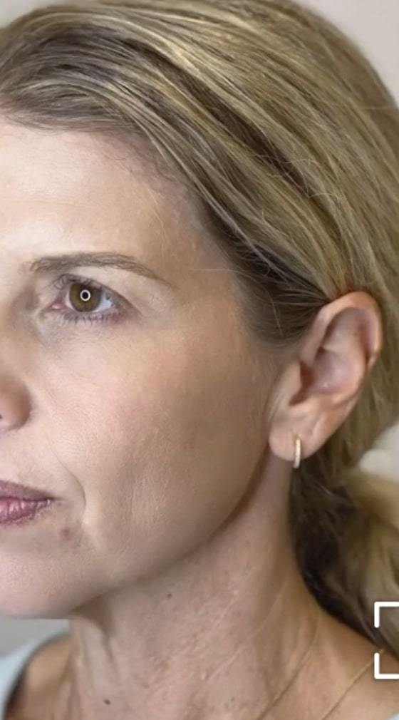 Chemical peel before and after: after treatment, a patient's face in profile with clearer, more even skin