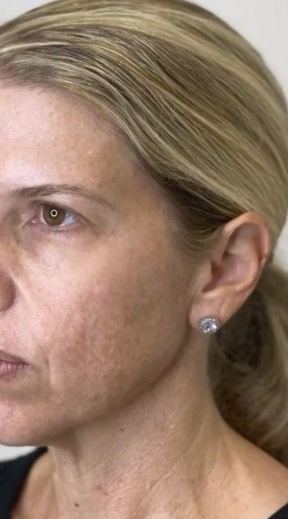 Chemical peel before and after: before treatment, a patient's face in profile with uneven skin tone and freckling