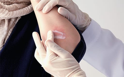 Stock photograph of models: a gloved clinician applies cream to a red patch on the inside of a model's elbow