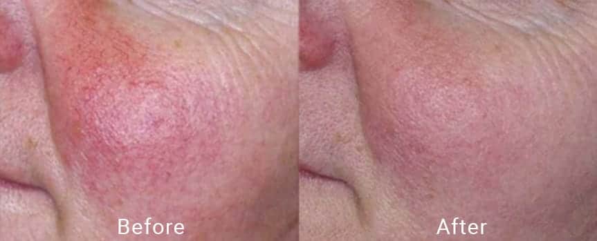 Rosacea treatment at FADC