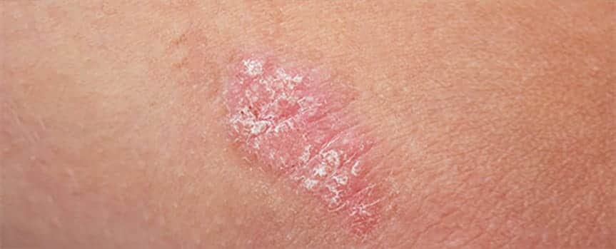 Psoriasis Treatment Coral Gables FL