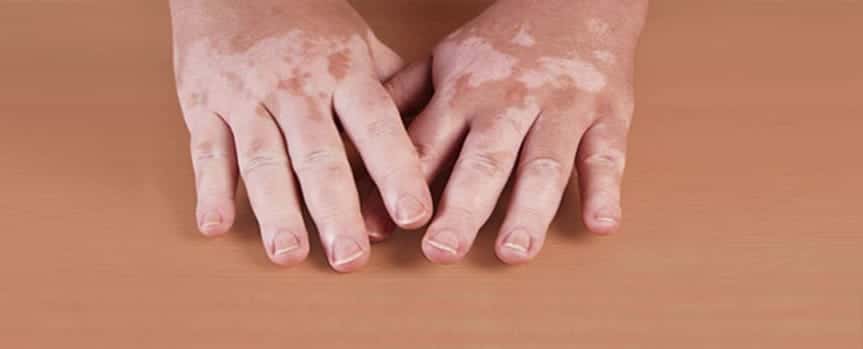 pair of hands laying on table with varying levels of pigment, or vitiligo