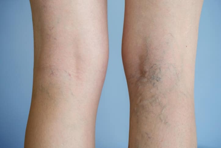 Am I a Good Candidate for Excel V Laser Treatment?