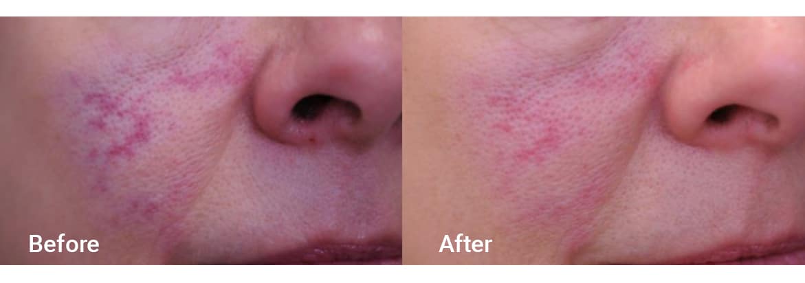 FADC Before & After Gallery Image 10