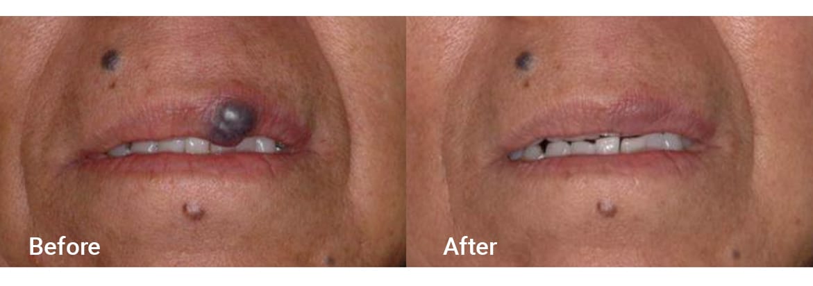 FADC Before & After Gallery Image 12