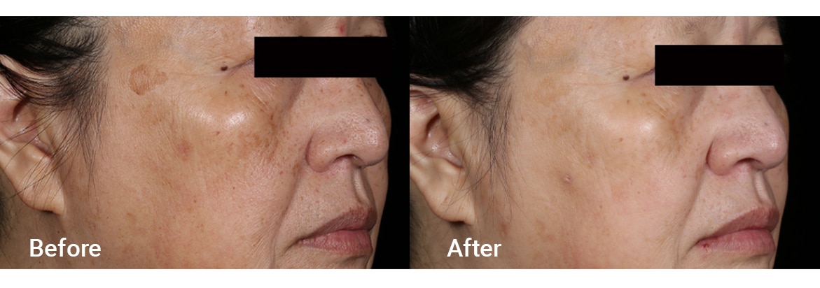 FADC Before & After Gallery Image 13