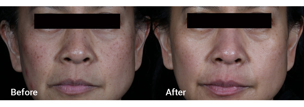 FADC Before & After Gallery Image 14