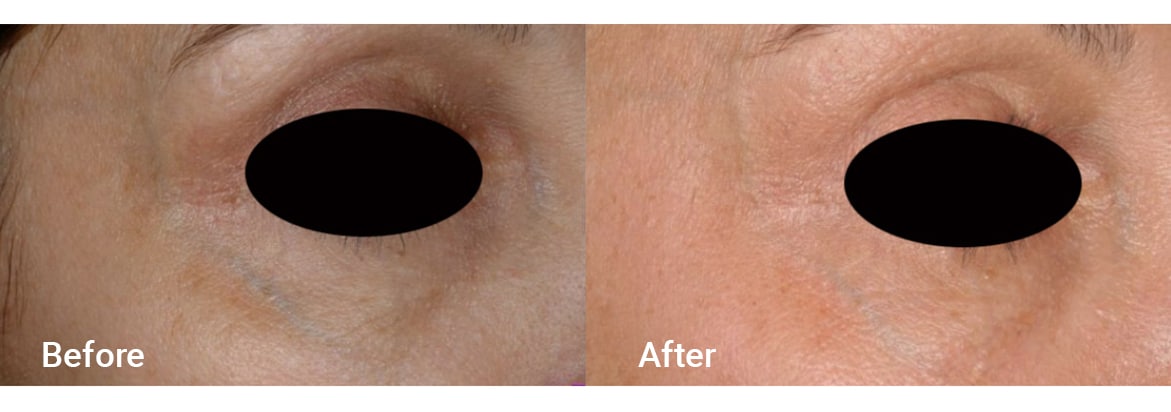 FADC Before & After Gallery Image 16