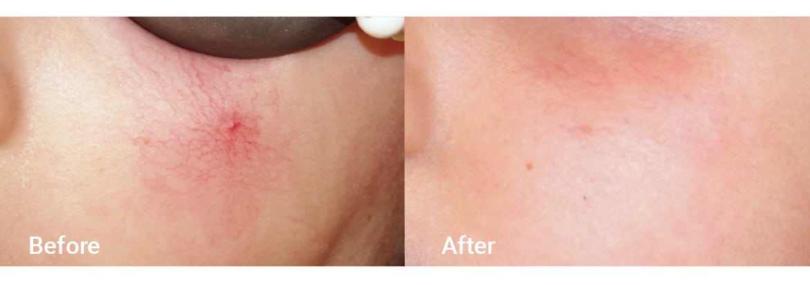 FADC Before & After Gallery Image 17