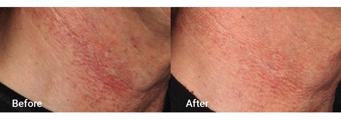 FADC Before & After Gallery Image 18