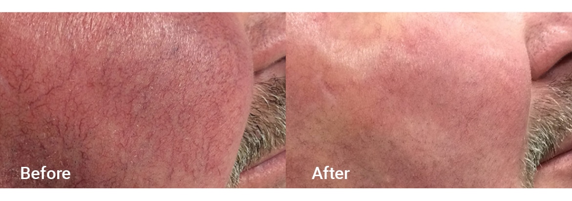 FADC Before & After Gallery Image 1
