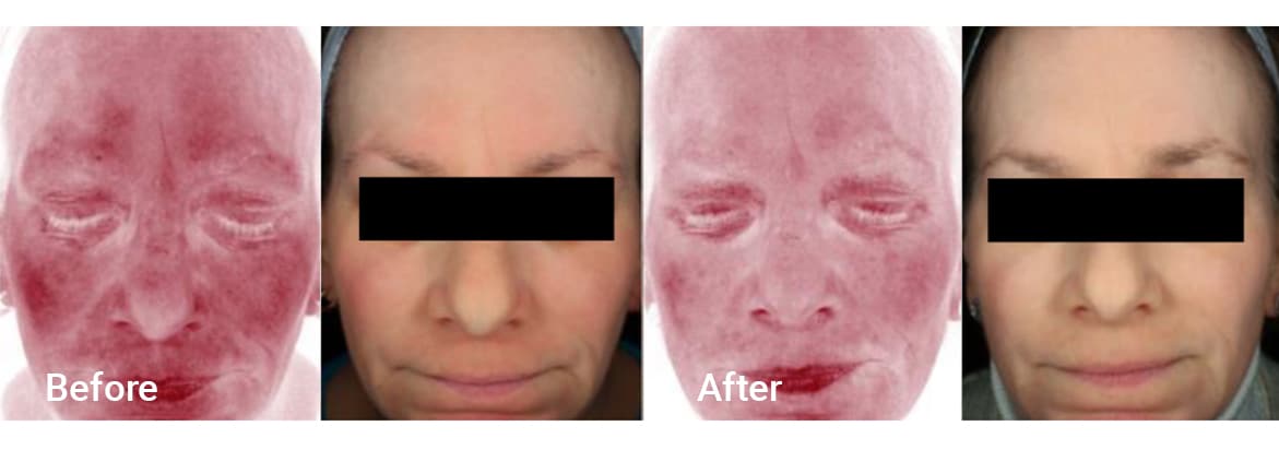 FADC Before & After Gallery Image 20