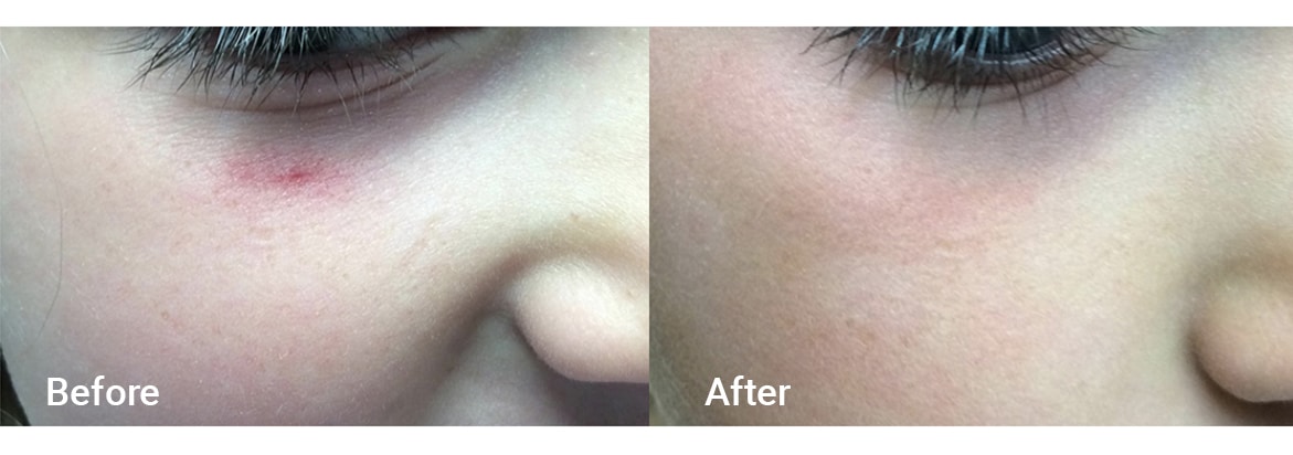 FADC Before & After Gallery Image 3