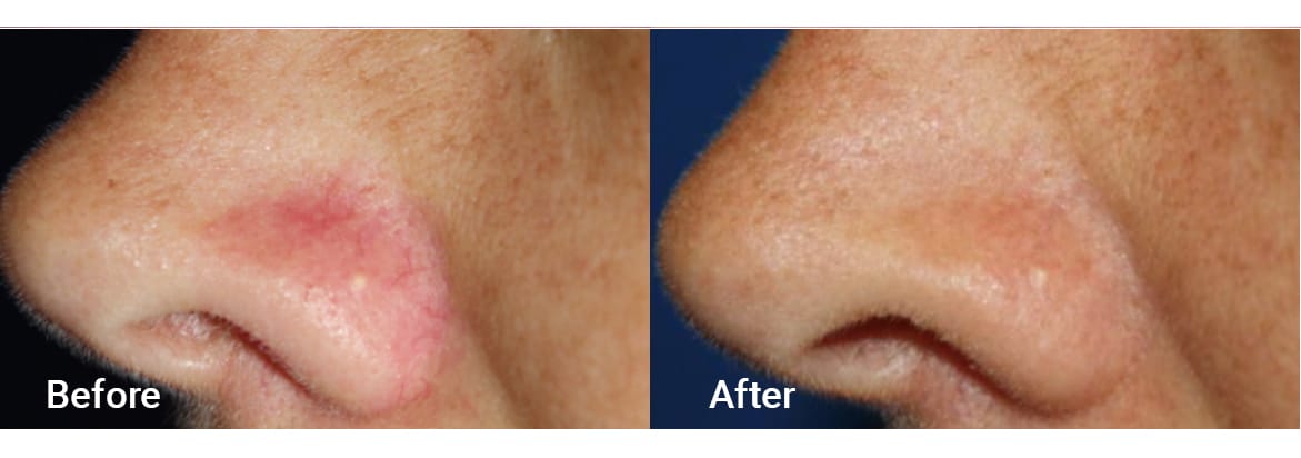 FADC Before & After Gallery Image 4