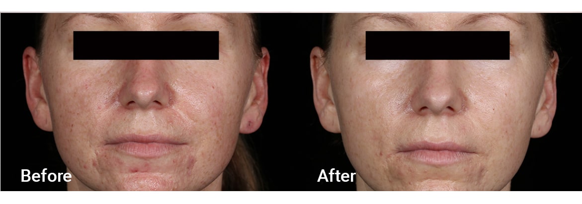 FADC Before & After Gallery Image 5