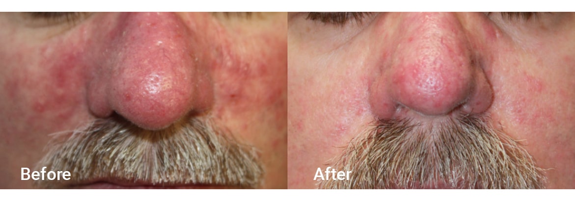 FADC Before & After Gallery Image 6