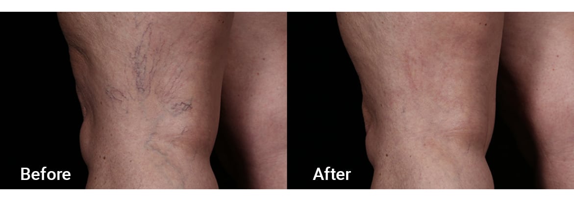 FADC Before & After Gallery Image 7