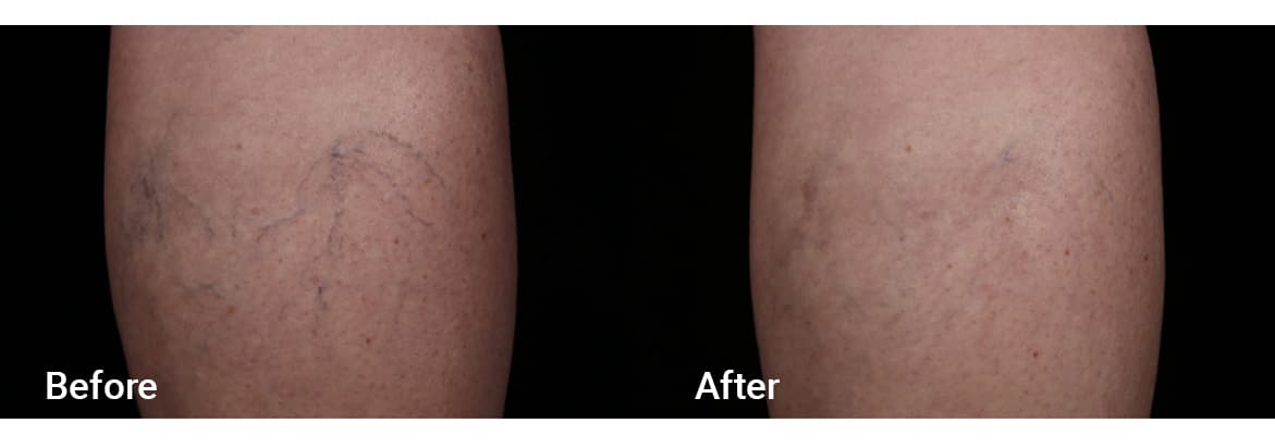FADC Before & After Gallery Image 8