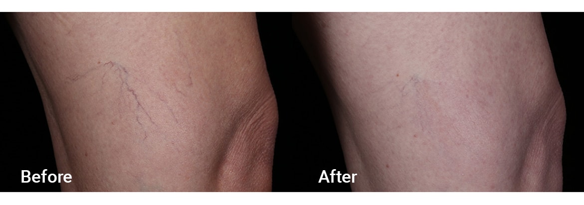 FADC Before & After Gallery Image 9