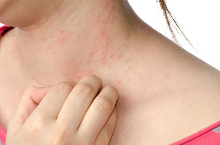 Stress and Eczema