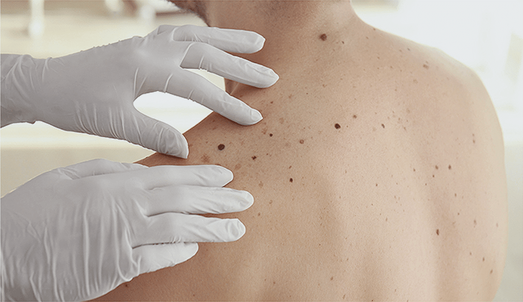 Stock photograph of a model: gloved hands examining moles on a man's bare shoulder and back