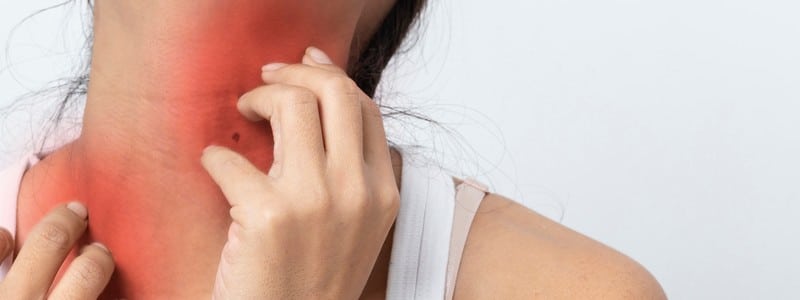 Stock photograph of a model: a woman scratching her reddened neck and shoulder